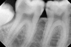 Radiografia carie