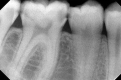 Radiografia carie