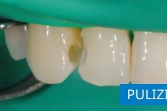 Pulizia  carie