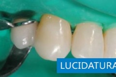 Lucidatura carie