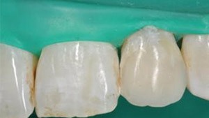 Dente ricostruito dopo carie