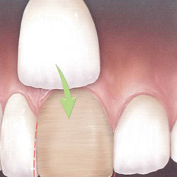 faccette estetiche in ceramica