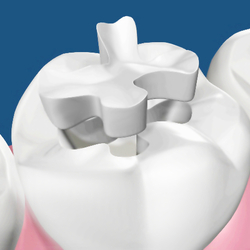 intarsi dentali