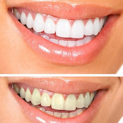 sbiancamento denti