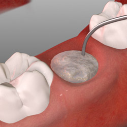 impianti denti assenza osso