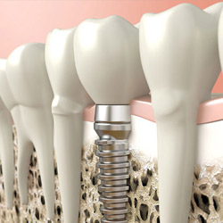 impianto dentale osteointegrato
