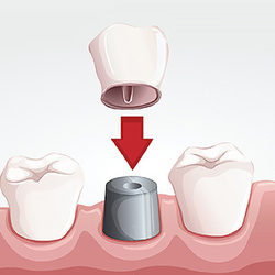 corone dentali ricopertura dente