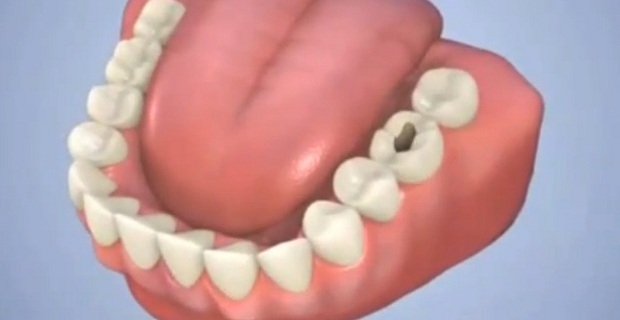 Dente cariato