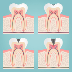 endodonzia cura canalare devitalizzazione