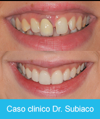 Applicazione delle faccette in ceramica
