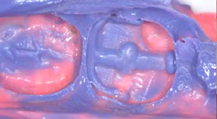 Impronta del dente