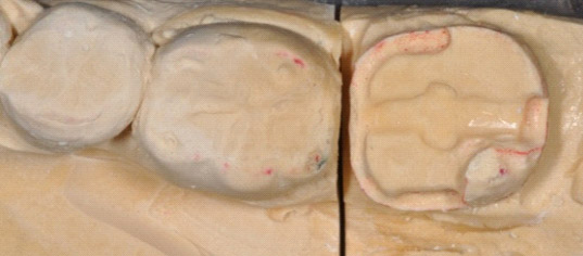 Caratteristiche di un intarsio dentale