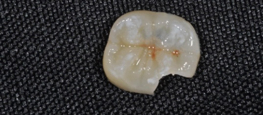intarsio dentale