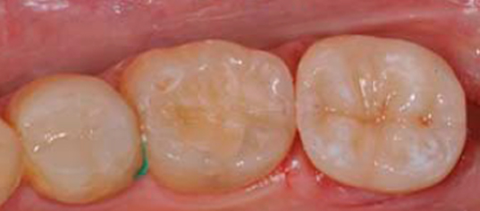 Caratteristiche di un intarsio dentale