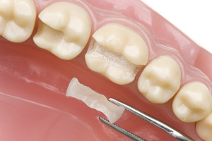 Intarsi dentali