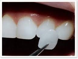 Le faccette estetiche