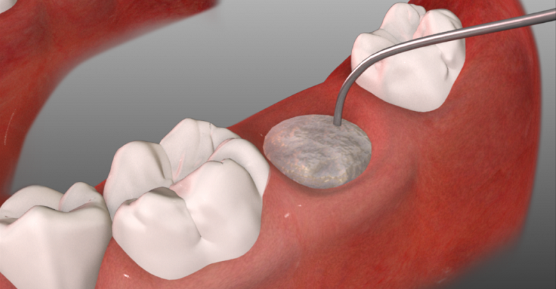 Impianti dentali in assenza di osso